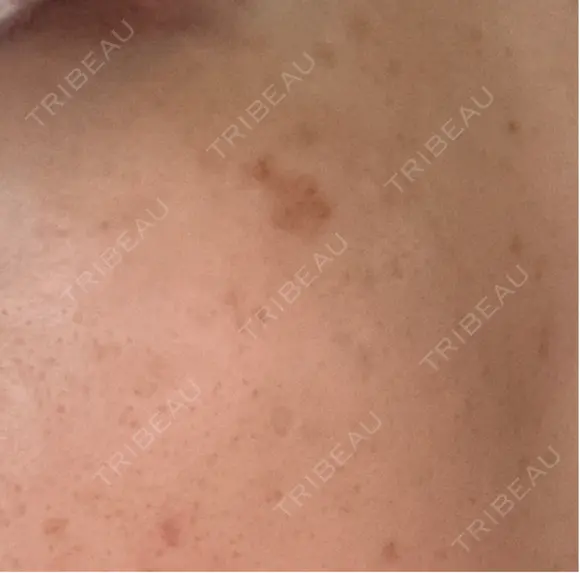 ルメッカ Clinic K Blossom DAY 6 メイン用