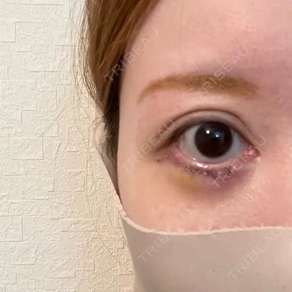 下まぶたたるみ取り / その他（目元） ネビュラクリニック 京都院 DAY 5 メイン用