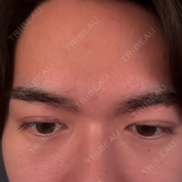 眼瞼下垂（切開） / 上まぶたの脂肪取り 新前橋かしま眼科形成外科クリニック DAY 64 メイン用