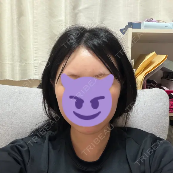 脂肪吸引（顔） / ボトックス（エラ・小顔） WOM CLINIC GINZA （ワム クリニック ギンザ） DAY 31 メイン用