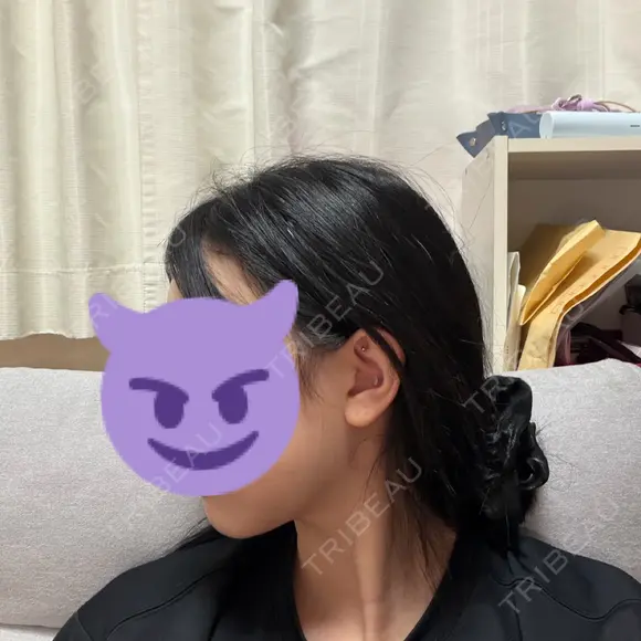 脂肪吸引（顔） / ボトックス（エラ・小顔） WOM CLINIC GINZA （ワム クリニック ギンザ） DAY 31 メイン用