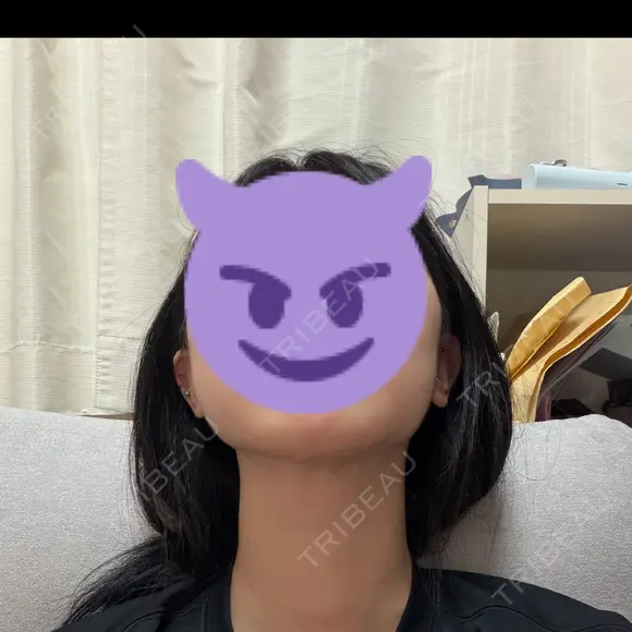 脂肪吸引（顔） / ボトックス（エラ・小顔） WOM CLINIC GINZA （ワム クリニック ギンザ） DAY 31 メイン用