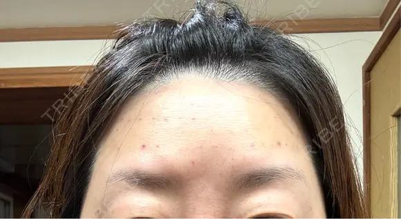 ボトックス（エラ・小顔） / マイクロボトックス / ボトックス（眉間） 札幌美容外科ネビュラクリニック DAY 32 メイン用
