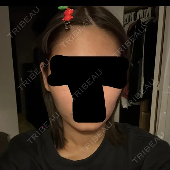 ボトックス（エラ・小顔） 札幌TAクリニック DAY 10 メイン用