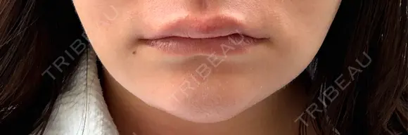 ヒアルロン酸注入（唇） 目白ホワイトクリニック DAY 0 メイン用