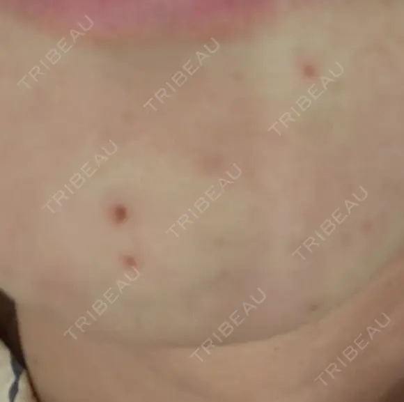 ほくろ・いぼ除去レーザー（肌） プライベートスキンクリニック 梅田本院 DAY 0 メイン用