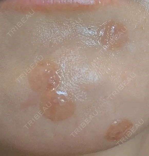 ほくろ・いぼ除去レーザー（肌） プライベートスキンクリニック 梅田本院 DAY 0 メイン用