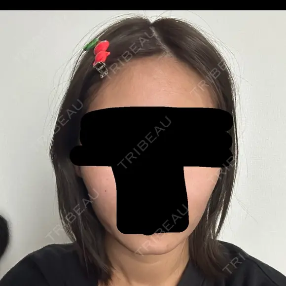 ボトックス（エラ・小顔） 札幌TAクリニック AFTER メイン用