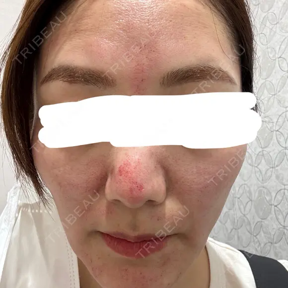 ピコレーザートーニング（美白・肝斑） / ピコフラクショナルレーザー（毛穴・ニキビ跡） 東京シルククリニック 新宿院 DAY 0 メイン用