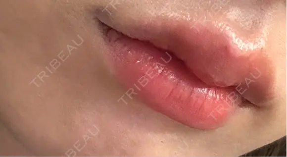 ヒアルロン酸注入（唇） 目白ホワイトクリニック DAY 0 メイン用