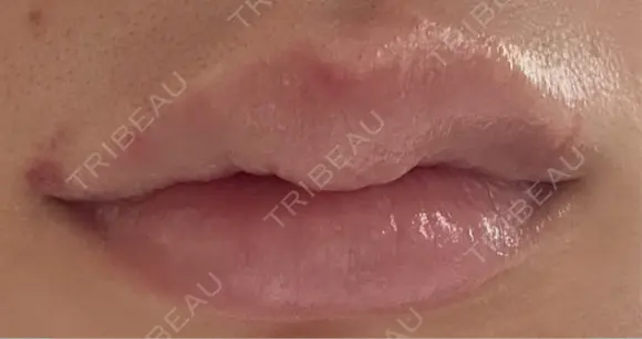 ヒアルロン酸注入（唇） 目白ホワイトクリニック DAY 1 メイン用