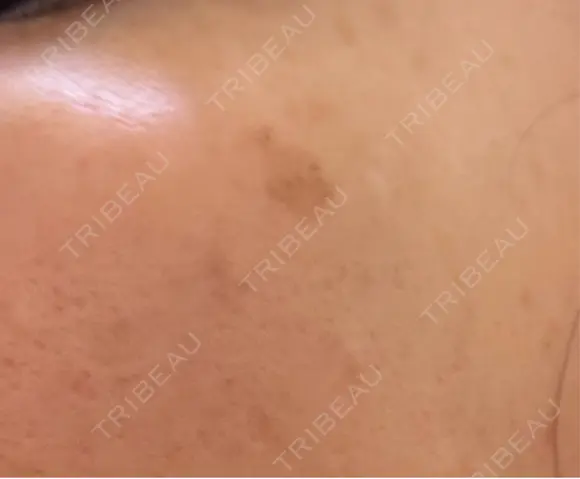 ルメッカ Clinic K Blossom DAY 7 メイン用