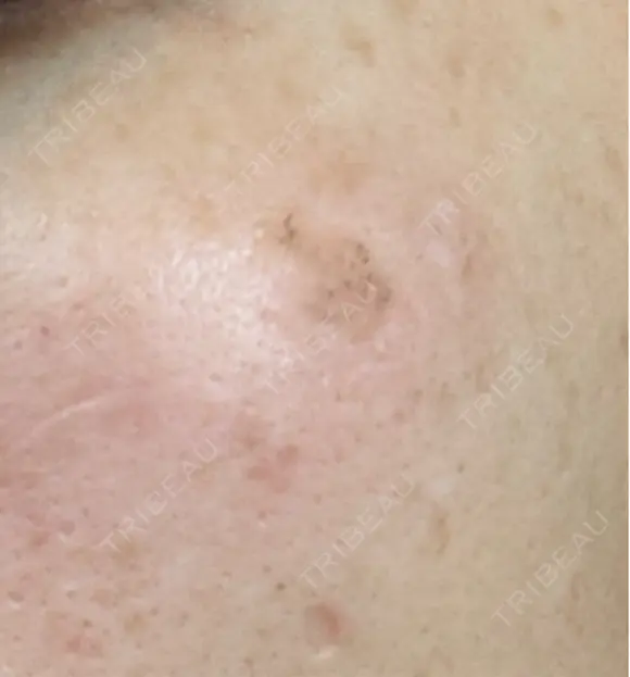 ルメッカ Clinic K Blossom DAY 8 メイン用