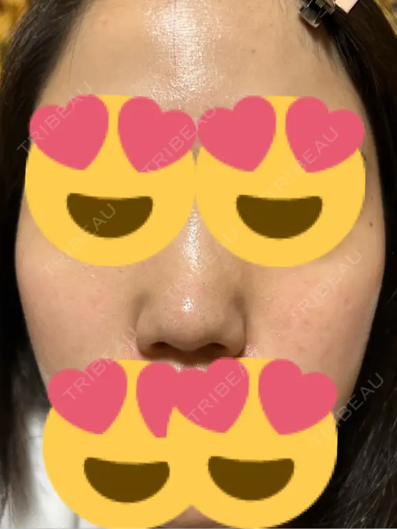 脂肪溶解注射（顔） ゆう美容クリニック DAY 0 メイン用