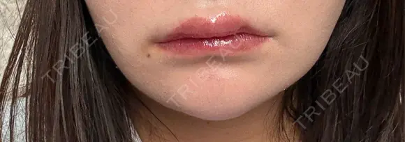 ヒアルロン酸注入（唇） 目白ホワイトクリニック DAY 2 メイン用