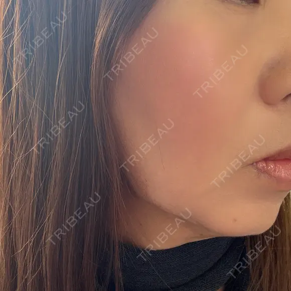 RF（高周波）たるみ治療 Wi Clinic （ウィ クリニック）心斎橋院 AFTER メイン用