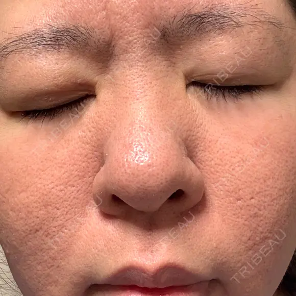 ニキビ治療 AB美容クリニック 新宿院 AFTER メイン用