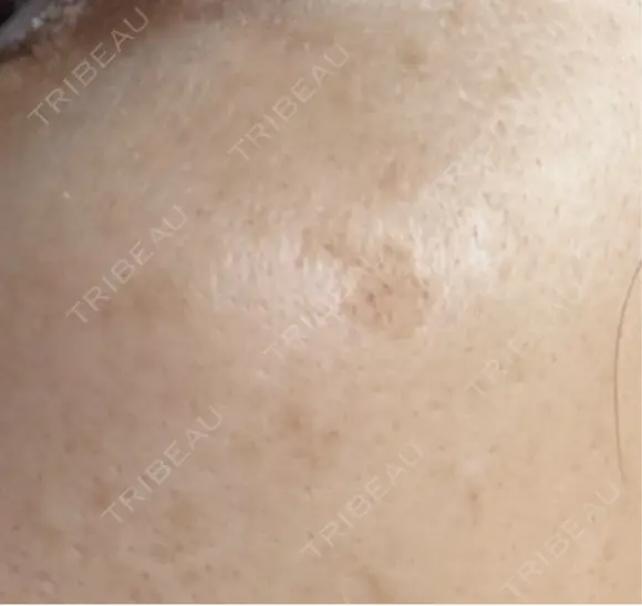 ルメッカ Clinic K Blossom AFTER メイン用