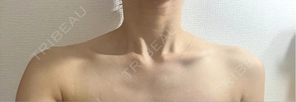 ボトックス（肩） Next Tokyo Clinic AFTER メイン用