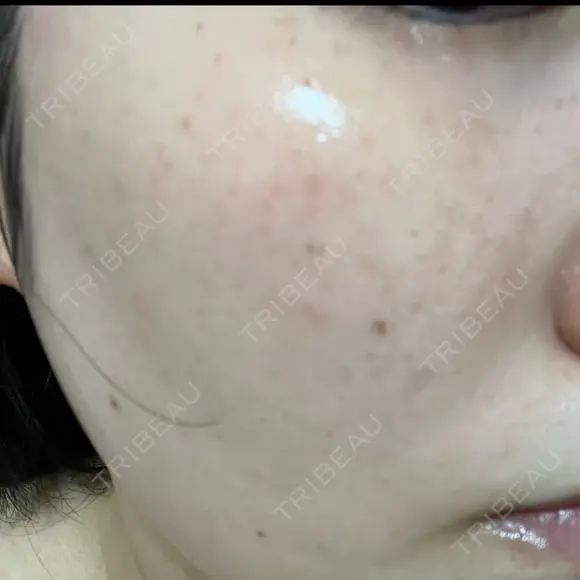 ルメッカ L‘amour clinic Tokyo【ラムールクリニック東京】 DAY 1 メイン用