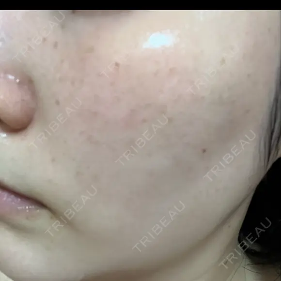 ルメッカ L‘amour clinic Tokyo【ラムールクリニック東京】 DAY 1 メイン用