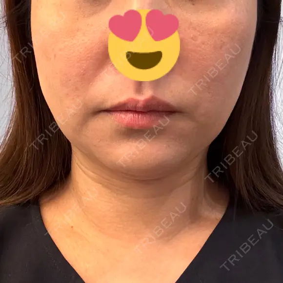 糸リフト / 脂肪吸引注射（顔） 新宿美容外科ネビュラクリニック DAY 22 メイン用