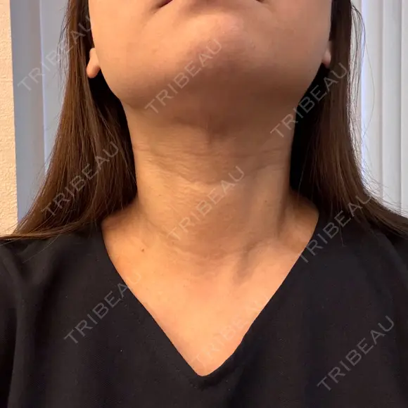 糸リフト / 脂肪吸引注射（顔） 新宿美容外科ネビュラクリニック DAY 22 メイン用