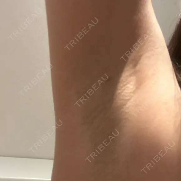 医療脱毛（ワキ） ルラ美容クリニック 新宿院 AFTER メイン用