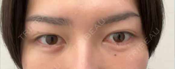 クマ治療 / その他（輪郭） WOM CLINIC GINZA （ワム クリニック ギンザ） DAY 30 メイン用