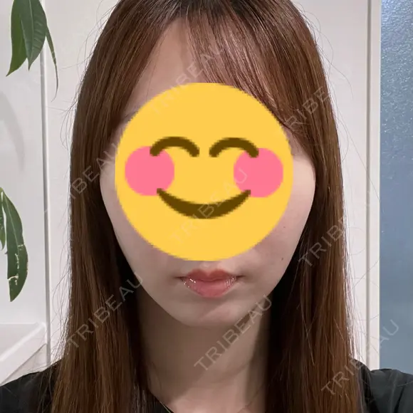 糸リフト 藤・ナチュレ美容クリニック 銀座院 AFTER メイン用