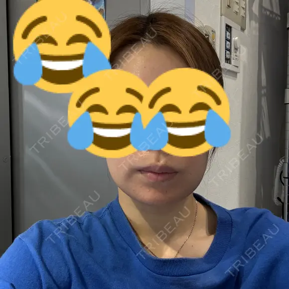 ボトックス（あご） / ボトックス（エラ・小顔） / 脂肪溶解注射（顔） / ボトックス（口角） / ボトックス（首） M'sクリニック【エムズクリニック】 AFTER メイン用