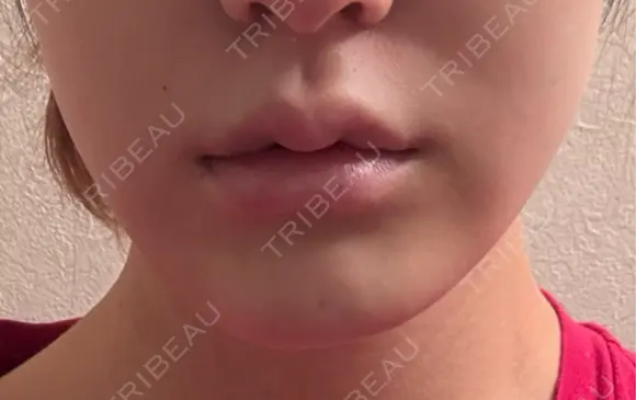 バッカルファット除去 ルラ美容クリニック 札幌本院 DAY 3 メイン用