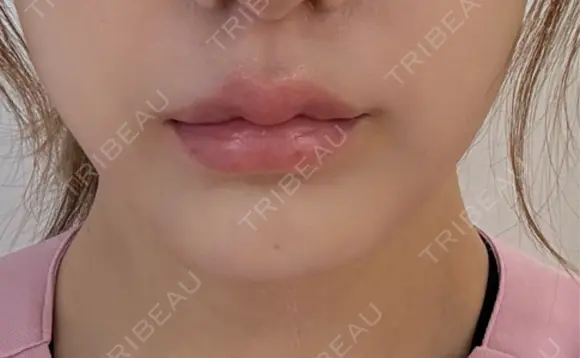 バッカルファット除去 ルラ美容クリニック 札幌本院 DAY 4 メイン用