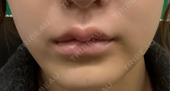 バッカルファット除去 ルラ美容クリニック 札幌本院 DAY 5 メイン用