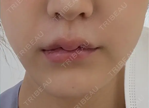 バッカルファット除去 ルラ美容クリニック 札幌本院 DAY 7 メイン用