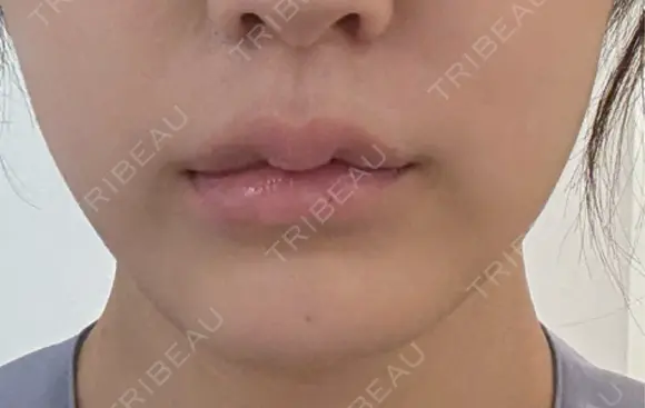 バッカルファット除去 ルラ美容クリニック 札幌本院 DAY 8 メイン用