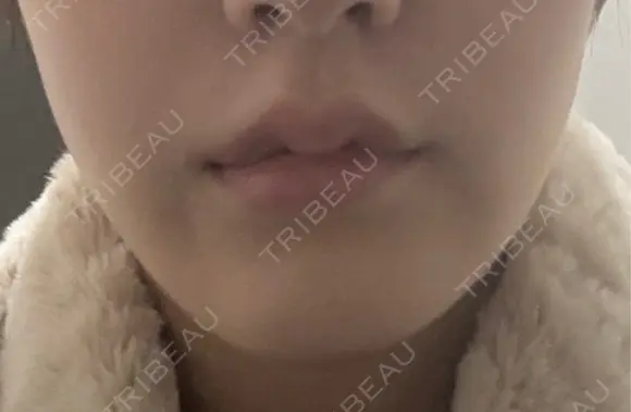 バッカルファット除去 ルラ美容クリニック 札幌本院 DAY 10 メイン用