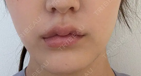 バッカルファット除去 ルラ美容クリニック 札幌本院 AFTER メイン用