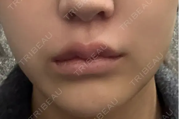 バッカルファット除去 ルラ美容クリニック 札幌本院 DAY 6 メイン用