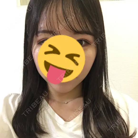 バッカルファット除去 / 脂肪吸引（顔） / ボトックス（エラ・小顔） / ヒアルロン酸注入（額） エートップ美容整形外科 DAY 89 メイン用