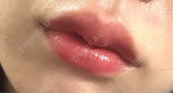 ヒアルロン酸注入（唇） 目白ホワイトクリニック AFTER メイン用