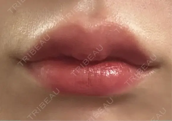 ヒアルロン酸注入（唇） 目白ホワイトクリニック DAY 4 メイン用