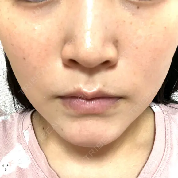 ルメッカ L‘amour clinic Tokyo【ラムールクリニック東京】 DAY 2 メイン用