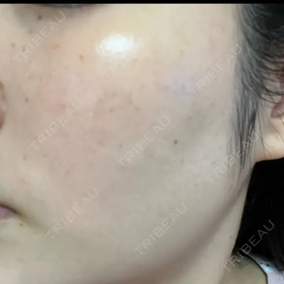 ルメッカ L‘amour clinic Tokyo【ラムールクリニック東京】 DAY 2 メイン用