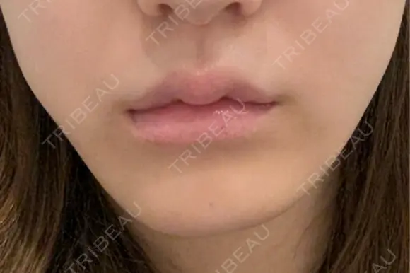 脂肪溶解注射（顔） 札幌美容外科ネビュラクリニック AFTER メイン用