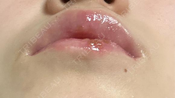 ヒアルロン酸注入（唇） / ボトックス（口角） ルラ美容クリニック 仙台院 / ルラスキンクリニック 仙台院 DAY 10 メイン用