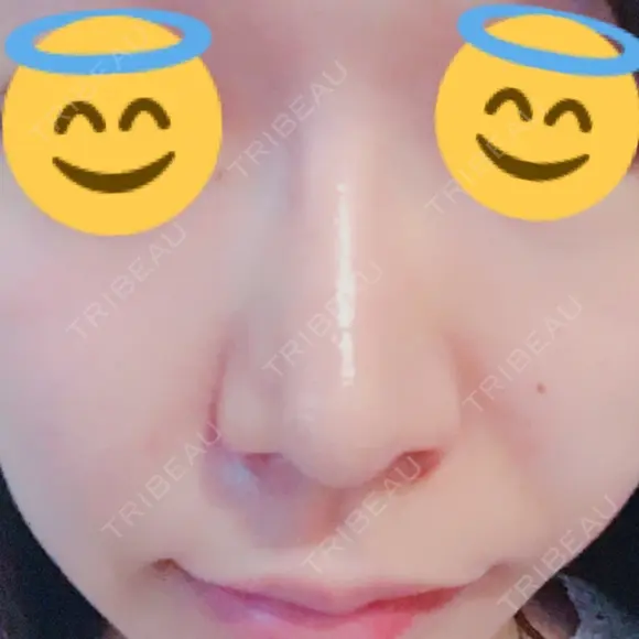 鼻孔縁挙上 / その他（鼻） シエルクリニック DAY 11 メイン用