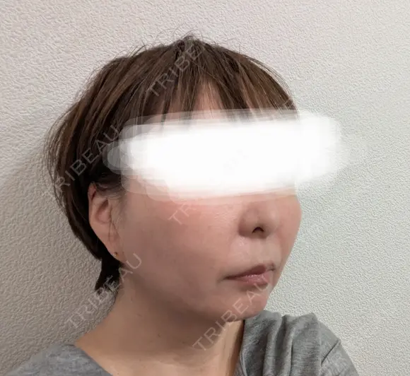 糸リフト / メーラーファット除去 / ジョールファット除去 / 脂肪吸引注射（顔） / ヒアルロン酸注入（鼻翼基部） ICON CLINIC DAY 114 メイン用