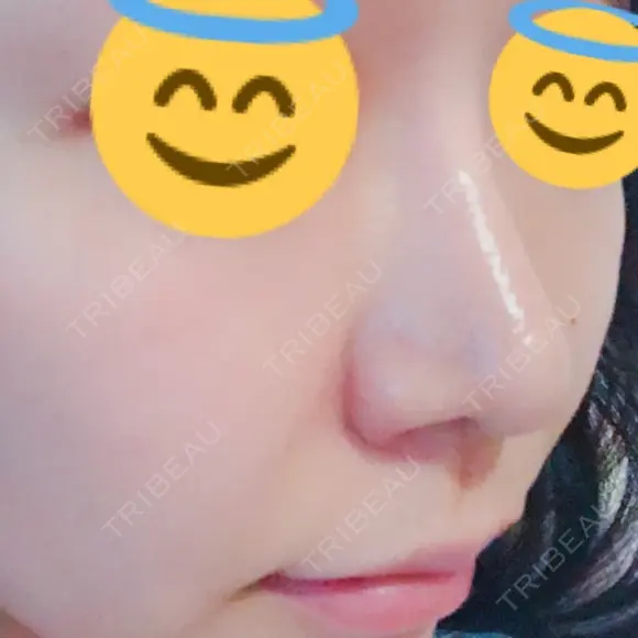 鼻孔縁挙上 / その他（鼻） シエルクリニック DAY 11 メイン用