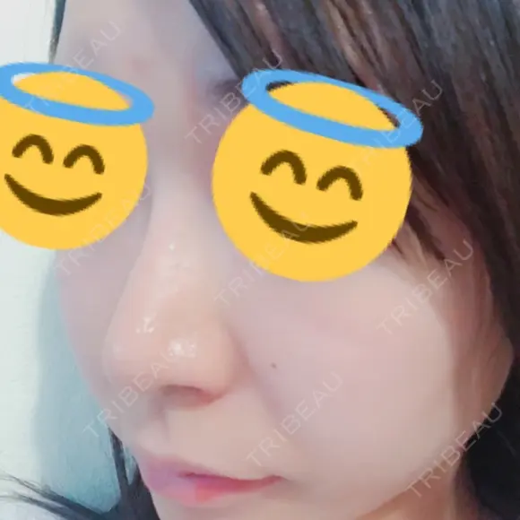 鼻孔縁挙上 / その他（鼻） シエルクリニック DAY 11 メイン用